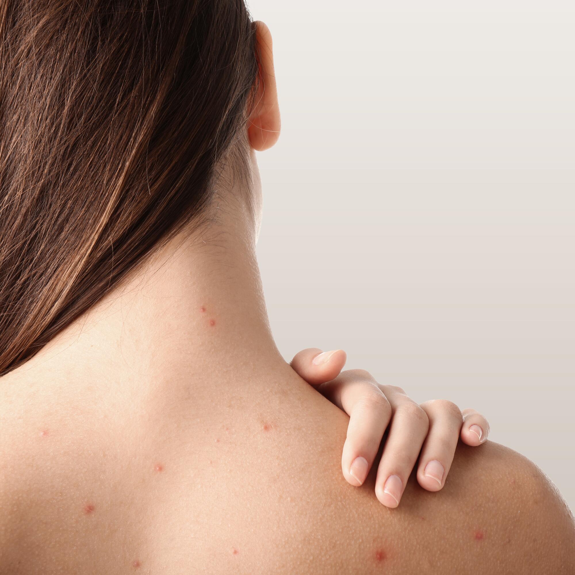 Les imperfections liées à l’acné sur le corps